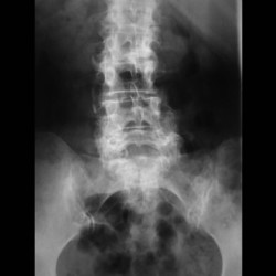 Espondiloartrosis-lumbar