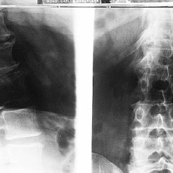 Espondilosis-lumbar