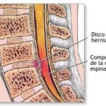 Síntomas de la hernia discal