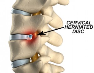 síntomas de la hernia cervical