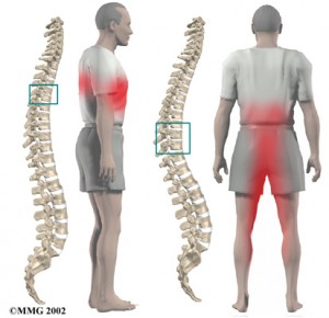 síntomas de la hernia dorsal