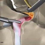 Cirugía de hernia discal