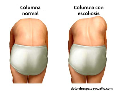 sintomas-de-escoliosis